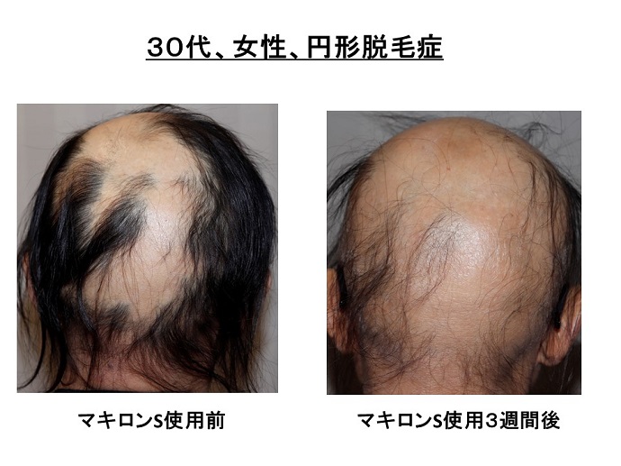 円形脱毛症　病院
